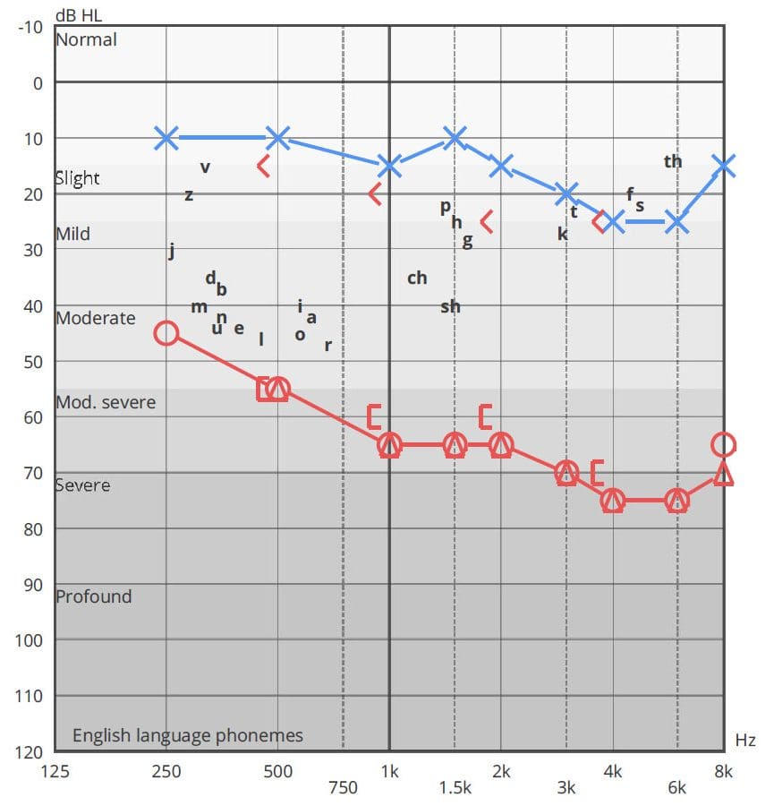 Graph showing the results of a real hearing test